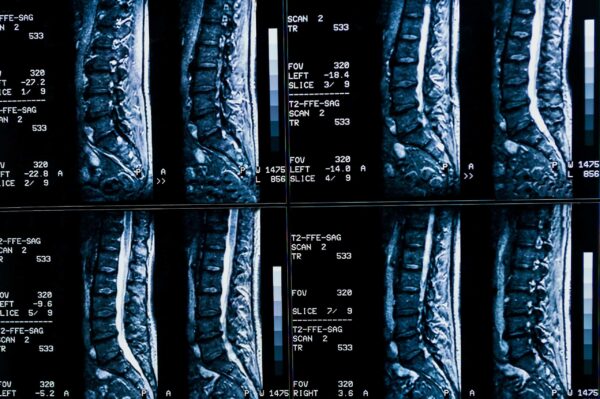 2025 The Anatomy of Coding - Other Spine Procedures