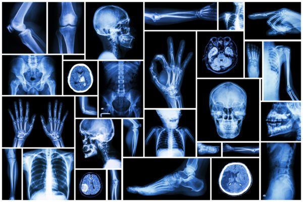 2025 The Anatomy of Coding - Total Joint Arthroplasty